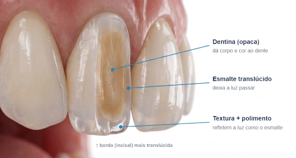 Facetas de resina
