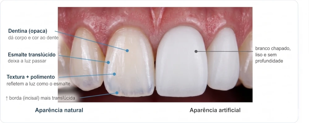 Comparação entre aparência natural e artificial de facetas: translucidez, variação de cor e microtextura versus branco chapado.