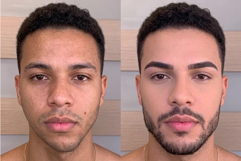 Harmonização Facial