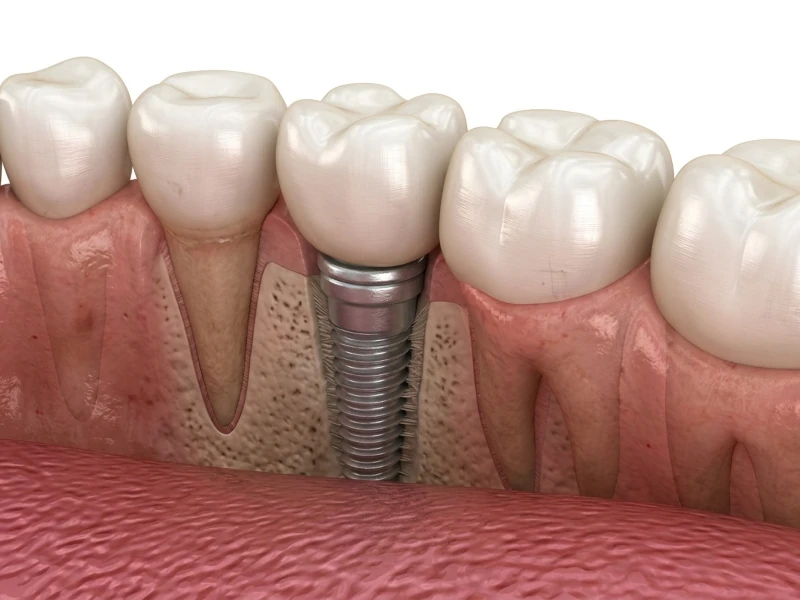 Implantes